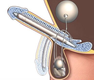 A penile prosthesis to enlarge it